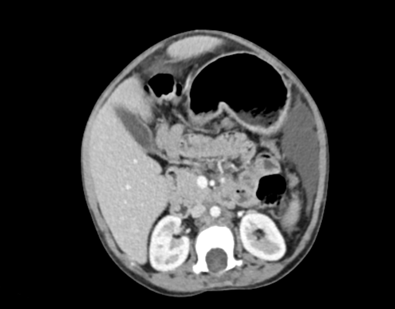 Abdominal premesenteric cystic lymphangioma (Radiopaedia 82995-97350 Axial C+ portal venous phase 24).jpg