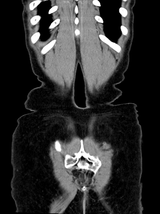 Abdominal wall and retroperitoneal tuberculosis (Radiopaedia 88137-104729 Coronal C+ portal venous phase 95).jpg