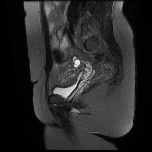 File:Abdominal wall endometriosis (Radiopaedia 83702-98847 Sagittal T2 fat sat 6).jpg