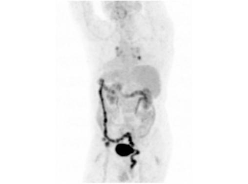 File:Abdominal wall metastasis from colorectal carcinoma (Radiopaedia 31016-31719 Rotational MIP 14).jpg