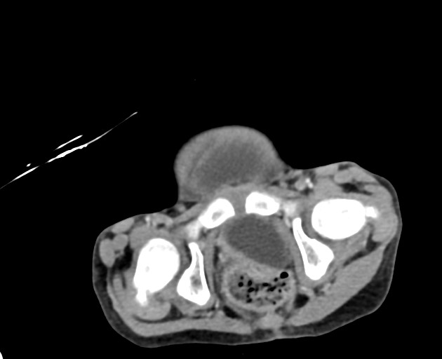 Abdominopelvic rhabdomyosarcoma (Radiopaedia 78356-90984 Axial C+ portal venous phase 151).jpg