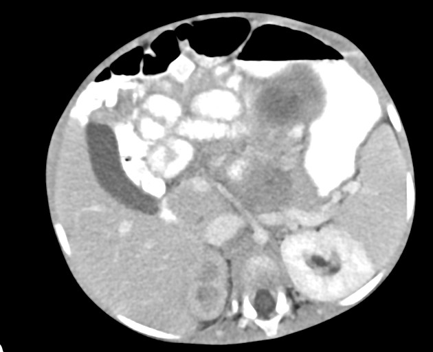 Abdominopelvic rhabdomyosarcoma (Radiopaedia 78356-90984 Axial C+ portal venous phase 64).jpg