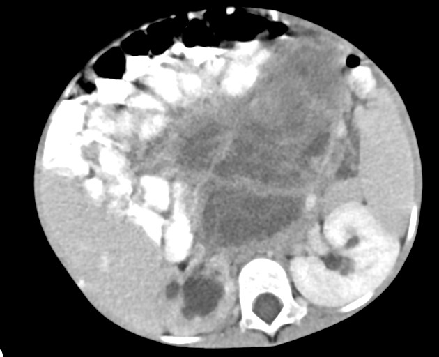 Abdominopelvic rhabdomyosarcoma (Radiopaedia 78356-90984 Axial C+ portal venous phase 74).jpg