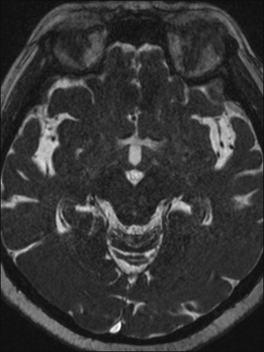 File:Abducens nerve palsy (Radiopaedia 57084-63976 Axial T2 ciss 3d 61).jpg