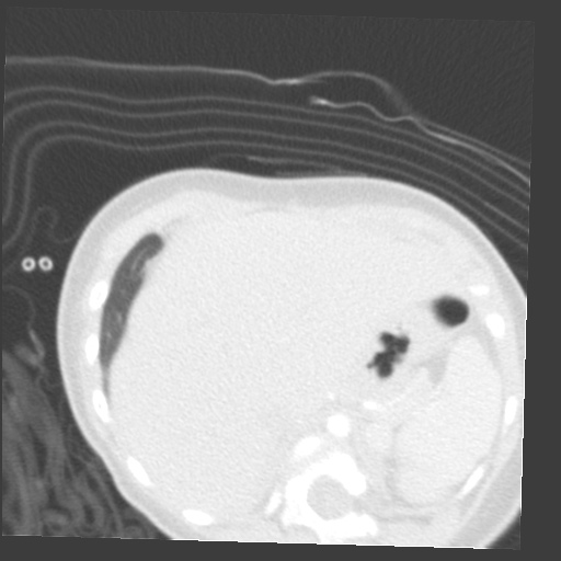 File:Aberrant left pulmonary artery (pulmonary sling) (Radiopaedia 42323-45435 Axial lung window 40).jpg