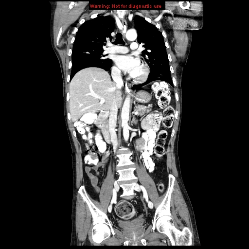 File:Aberrant right subclavian artery (Radiopaedia 9379-10071 Coronal C+ arterial phase 12).jpg