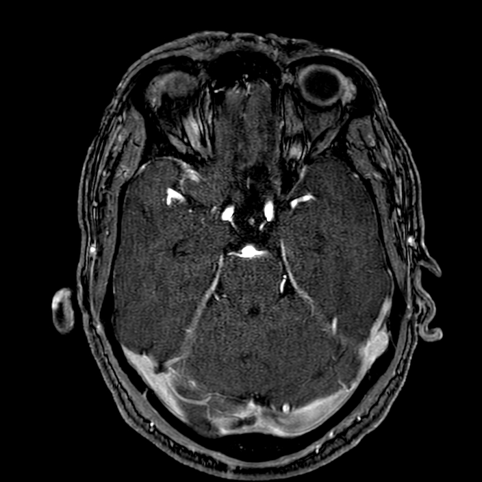 Accessory middle cerebral artery (Radiopaedia 73114-83828 Axial MRA 63).jpg