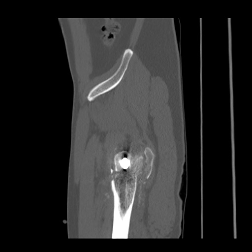 Acetabular and ilial fractures (Radiopaedia 59084-66378 Sagittal bone window 88).jpg