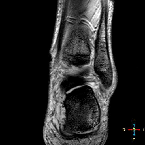 File:Achilles tendon complete tear (Radiopaedia 22834-22854 T2 fat sat 10).jpg