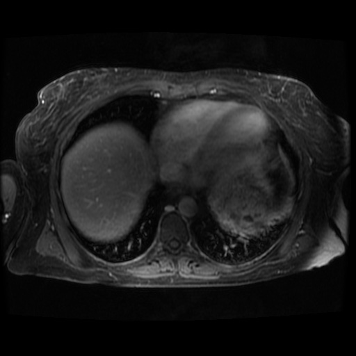 Acinar cell carcinoma of the pancreas (Radiopaedia 75442-86668 Axial T1 C+ fat sat 135).jpg
