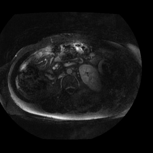 Acinar cell carcinoma of the pancreas (Radiopaedia 75442-86668 Axial T1 C+ fat sat 6).jpg