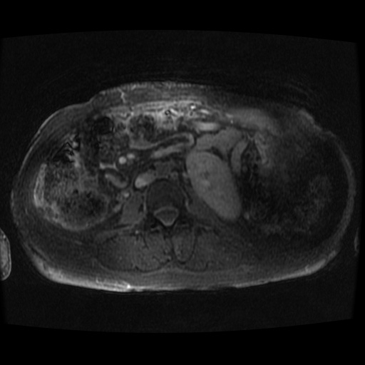 Acinar cell carcinoma of the pancreas (Radiopaedia 75442-86668 Axial late phase (~30 mins) 7).jpg