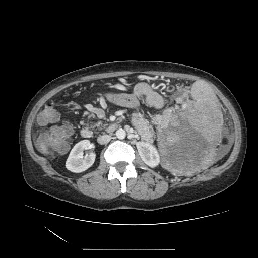 Acinar cell carcinoma of the pancreas (Radiopaedia 75442-86669 Axial C+ portal venous phase 62).jpg