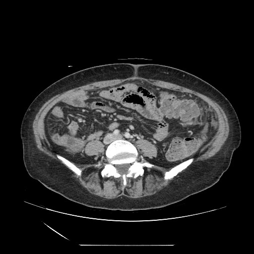 Acinar cell carcinoma of the pancreas (Radiopaedia 75442-86669 Axial C+ portal venous phase 93).jpg