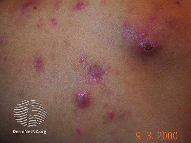 File:Acne affecting the back images (DermNet NZ acne-acne-back-184).jpg