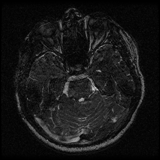 Acoustic schwannoma (Radiopaedia 33045-34060 Axial T2 60).png