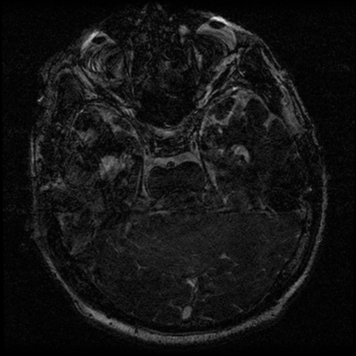 File:Acoustic schwannoma (Radiopaedia 39170-41387 Axial FIESTA 104).png
