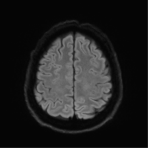 Acoustic schwannoma (Radiopaedia 50846-56358 Axial DWI 51).png