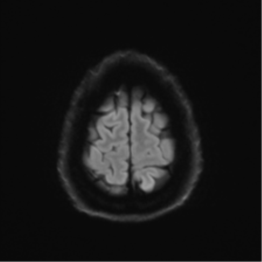 Acoustic schwannoma (Radiopaedia 50846-56358 Axial DWI 54).png