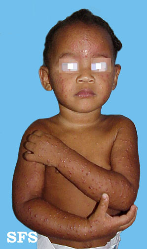 Acrodermatitis Infantile Papular (Dermatology Atlas 4).jpg