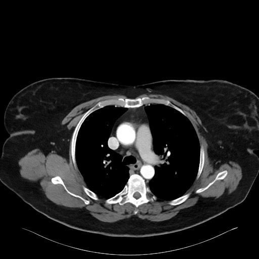 Acromioclavicular joint cyst (Radiopaedia 58455-65610 Axial C+ arterial phase 46).jpg