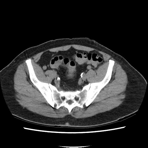 Active colonic bleed on CT (Radiopaedia 49765-55025 Axial non-contrast 66).jpg