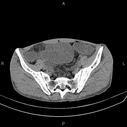 Active crohn disease (Radiopaedia 87133-103397 Axial non-contrast 81).jpg
