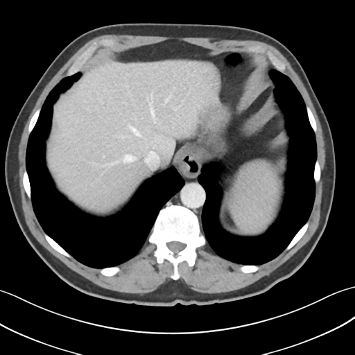 File:Active diverticular hemorrhage (Radiopaedia 39415-41725 Axial C+ portal venous phase 8).png