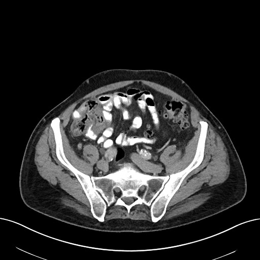 File:Active lower gastrointestinal bleeding - diverticular (Radiopaedia 61203-69106 Axial C+ portal venous phase 94).jpg