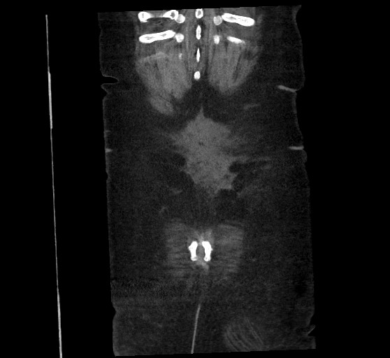 Active renal extravasation with large subcapsular and retroperitoneal hemorrhage (Radiopaedia 60975-68796 Coronal C+ arterial phase 139).jpg