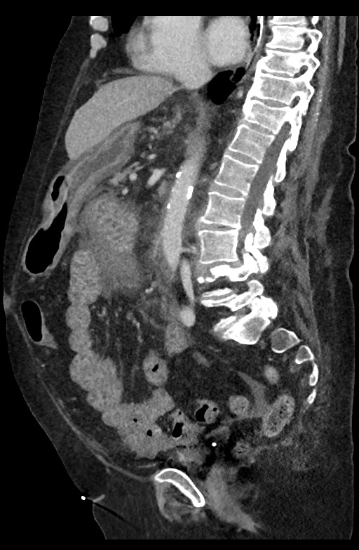 Active renal extravasation with large subcapsular and retroperitoneal hemorrhage (Radiopaedia 60975-68796 Sagittal C+ portal venous phase 124).jpg