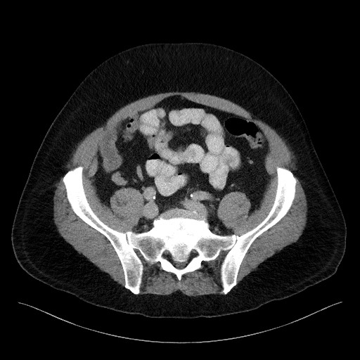 Acute-on-chronic pancreatitis (Radiopaedia 67286-76656 Axial C+ portal venous phase 59).jpg