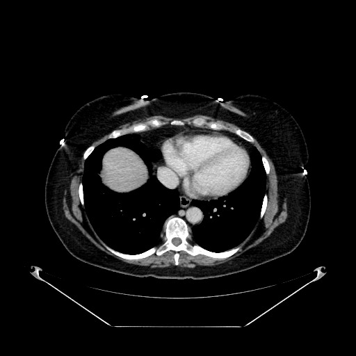 Acute appendicitis, heterotaxy syndrome (Radiopaedia 66884-76202 Axial C+ portal venous phase 11).jpg