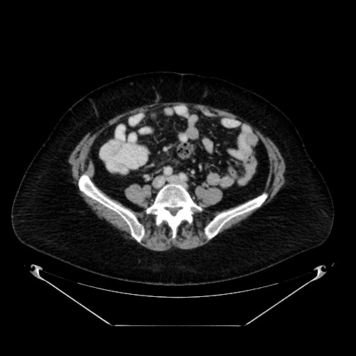 Acute appendicitis, heterotaxy syndrome (Radiopaedia 66884-76202 Axial C+ portal venous phase 84).jpg