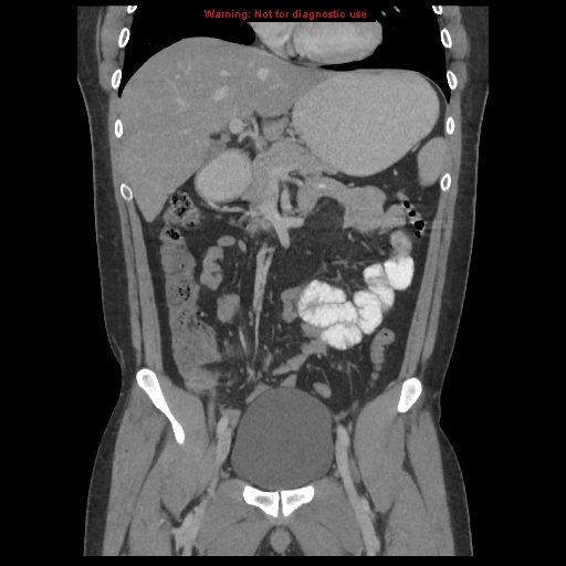 File:Acute appendicitis (Radiopaedia 10498-10973 F 11).jpg