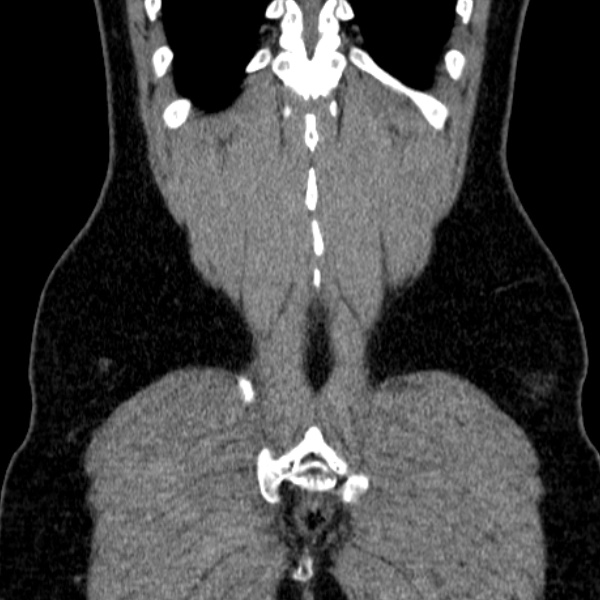 Acute appendicitis (Radiopaedia 38255-40270 Coronal C+ portal venous phase 78).jpg
