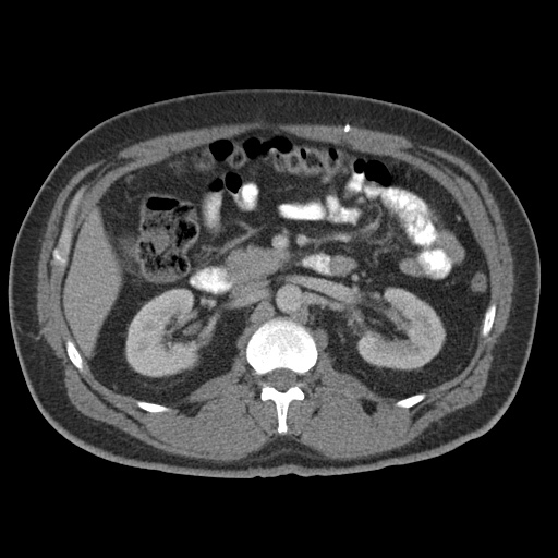 Acute appendicitis (Radiopaedia 48511-53463 Axial C+ portal venous phase 41).jpg