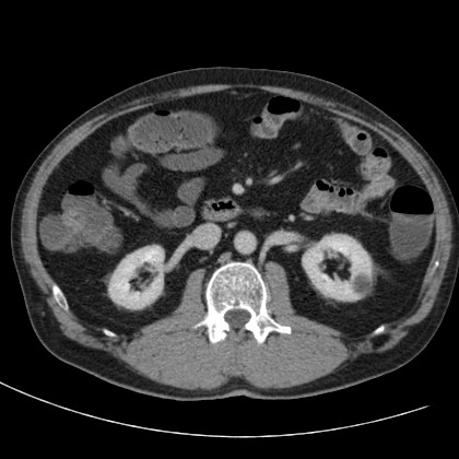 Acute appendicitis (Radiopaedia 66513-75790 Axial C+ portal venous phase 30).jpg