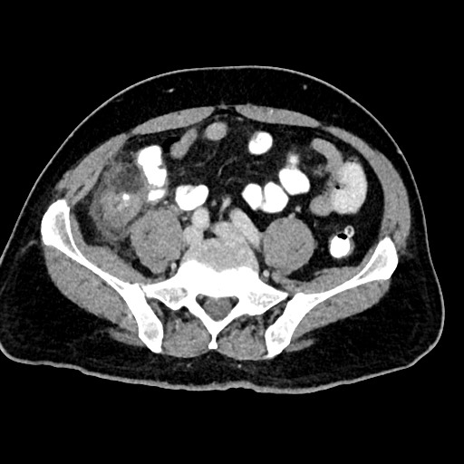 Acute appendicitis (Radiopaedia 77016-88960 Axial C+ portal venous phase 99).jpg