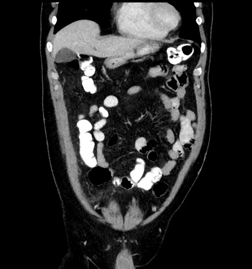 Acute appendicitis (Radiopaedia 77016-88960 Coronal C+ portal venous phase 32).jpg