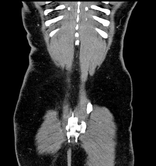 Acute appendicitis (Radiopaedia 77016-88960 Coronal C+ portal venous phase 88).jpg