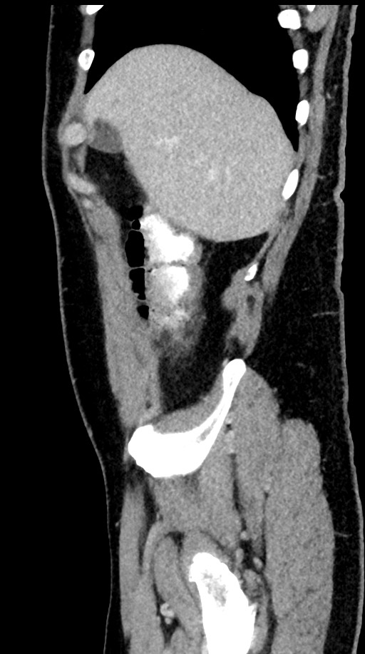 Acute appendicitis (Radiopaedia 77016-88960 Sagittal C+ portal venous phase 96).jpg