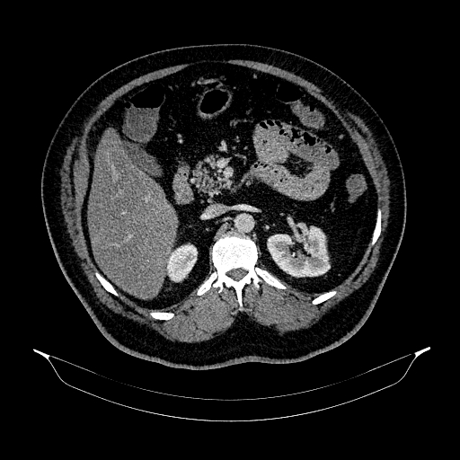 Acute appendicitis (Radiopaedia 79950-93224 Axial C+ portal venous phase 38).jpg