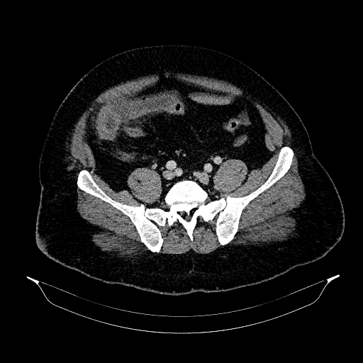 Acute appendicitis (Radiopaedia 79950-93224 Axial C+ portal venous phase 76).jpg