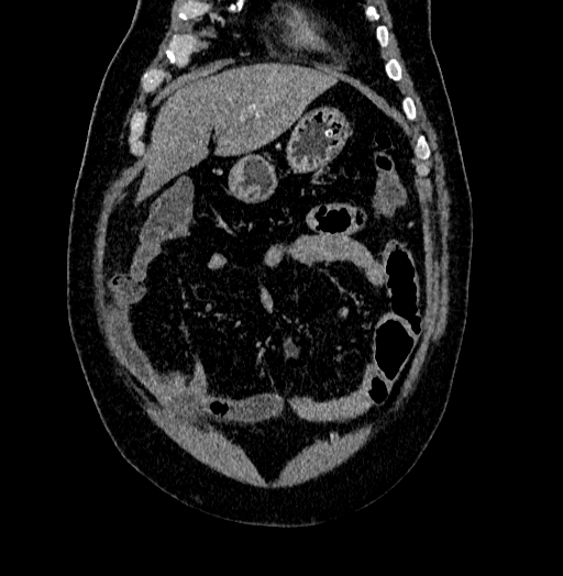 File:Acute appendicitis (Radiopaedia 79950-93224 Coronal C+ portal venous phase 17).jpg