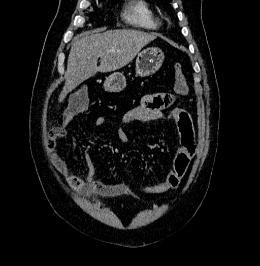 Acute appendicitis (Radiopaedia 79950-93224 Coronal C+ portal venous phase 19).jpg