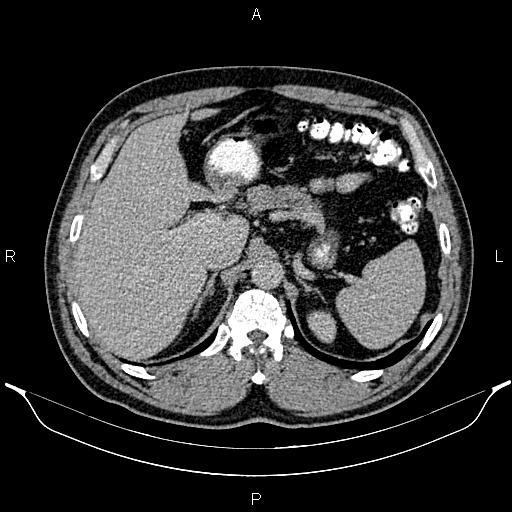 File:Acute appendicitis (Radiopaedia 84780-100240 Axial C+ portal venous phase 27).jpg