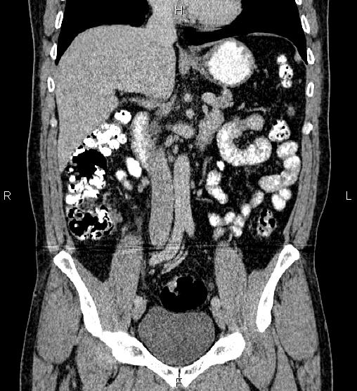 Acute appendicitis (Radiopaedia 84780-100240 Coronal C+ portal venous phase 38).jpg