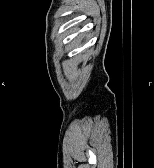 File:Acute appendicitis (Radiopaedia 84780-100240 Sagittal C+ portal venous phase 106).jpg