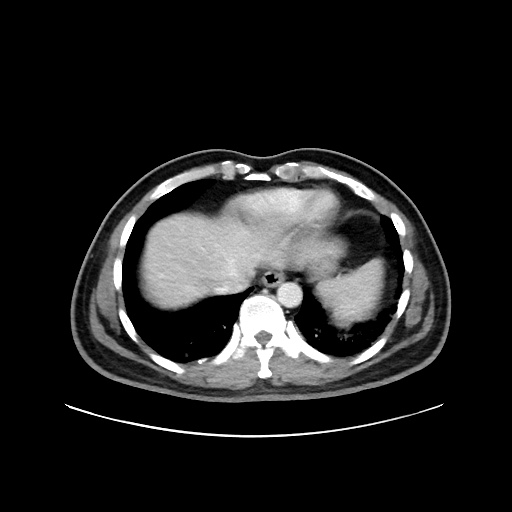 File:Acute appendicitis and COVID 19 pneumonia (Radiopaedia 76604-88380 Axial C+ portal venous phase 7).jpg